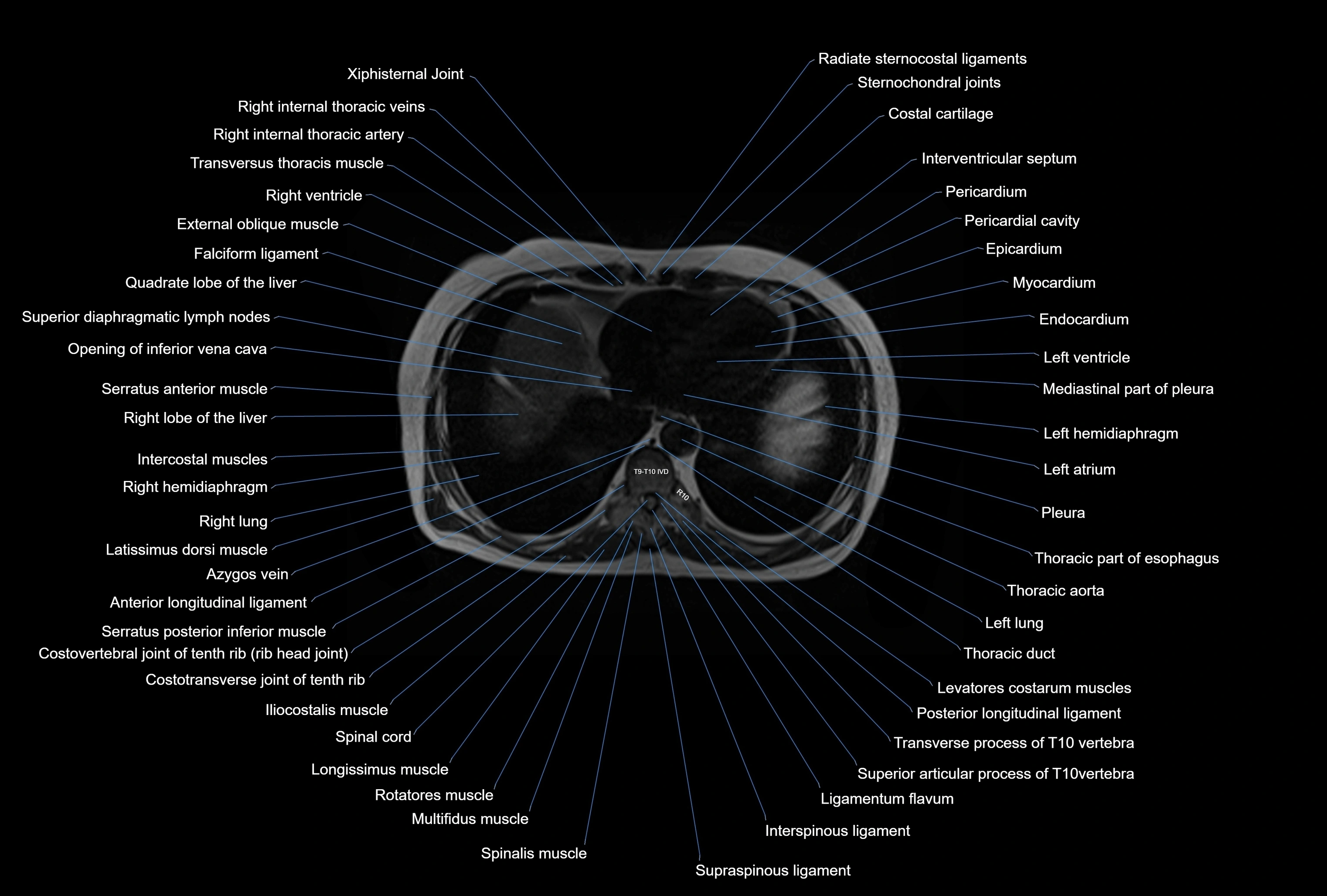 MRI Abdomen axial cross sectional anatomy radiology  image-img-00001-00003.webp